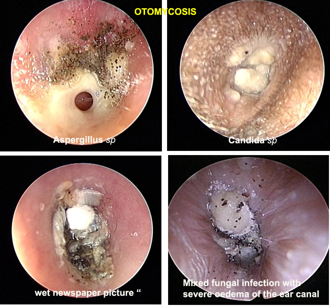 60 Otomycosis Medical Junkies